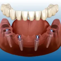 All on four implant