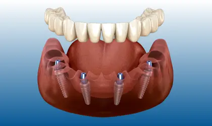 All on four implant