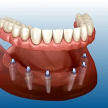 All on six implant, all-on-6 tedavisi