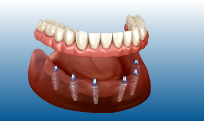All on six implant, all-on-6 tedavisi