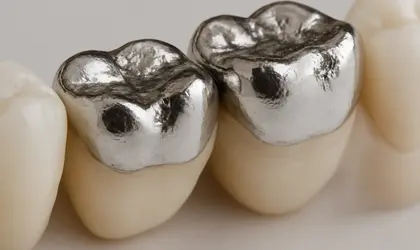 Amalgam dolgu; arka azı dişlerinde uygulanmış metalik görünümlü geleneksel gümüş dolgu restorasyonu.