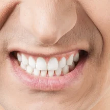 Bruksizm diş sıkma belirtirleri, diş sıkma tedavisi