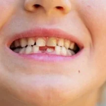 Çocuklarda diş çürüğü