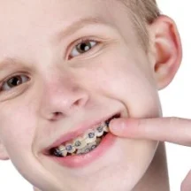 Çocuklarda ortodonti ve diş teli tedavisi