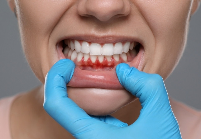 Diş eti iltihabı muayenesi, periodontoloji uzmanı tarafından diş eti hastalıklarının teşhisi