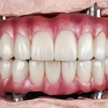 İmplant üstü protez ve implant destekli protetik tedaviler