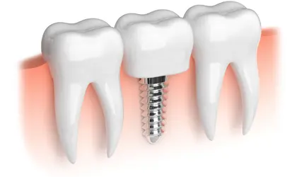 Ankara implant tedavisi Piano Dental Clinic