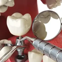 Çene kemiğine sabitlenmiş implant ve porselen kuron modeli