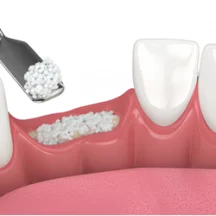 Çene kemiği yetersiz olduğunda, hastanın kendi kemik dokusu veya sentetik kemik ikameleri kullanılarak eksik bölge doldurulur