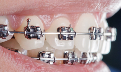 Piano Dental Clinic ortodontik tedavi ve diş teli fiyatları