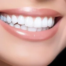 Tam Seramik Kaplamalar - Diş Teli