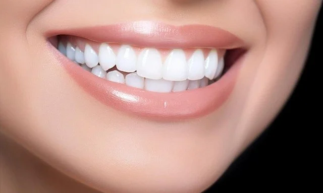 Tam Seramik Kaplamalar - Diş Teli