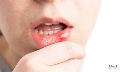 aft-ve-ucuk | Piano Dental Clinic | Estetik Diş Hekimliği | Dental İmplantlar aft ve uçuk