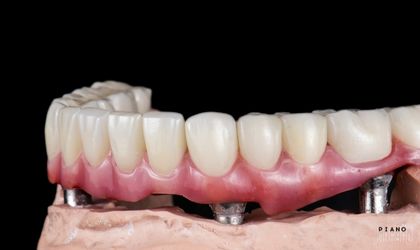 All On Four implant tekniği