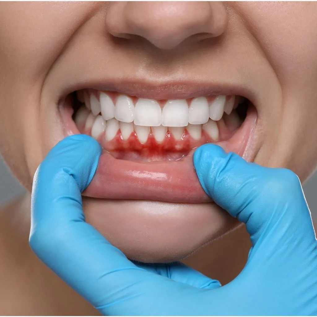 Diş eti çekilmesi belirtileri ve diş hekimi muayene