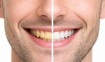 disbeyazlatma yontemleri | Piano Dental Clinic | Estetik Diş Hekimliği | Dental İmplantlar