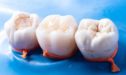 Diş dolguları ve restoratif tedaviler