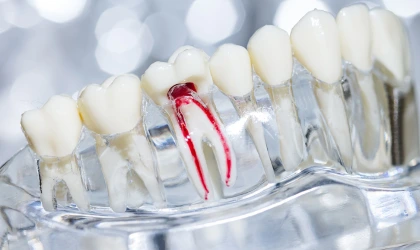 Endodonti kanal tedavisi