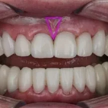 Frenilektomi Periodontolog tarafından uygulanan Dudak-Dil Bağı Alınma Tedavisi