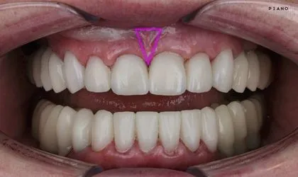 Frenilektomi Periodontolog tarafından uygulanan Dudak-Dil Bağı Alınma Tedavisi