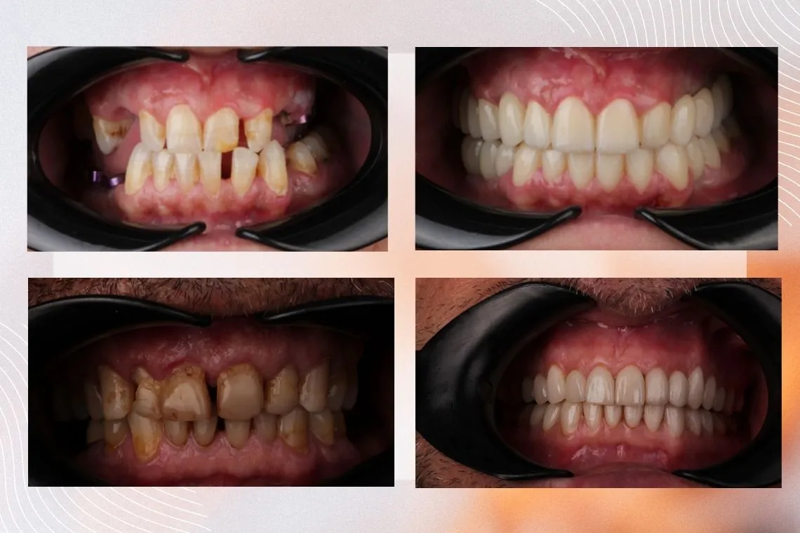 Piano Dental Clinic gülüş tasarımı örnekleri