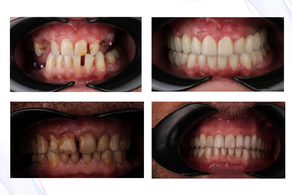 Gülüş Tasarımı Uygulama Sonuçları