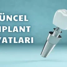 2025 Yılı Güncel İmplant Fiyatları Listesi