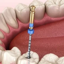 Kanal Tedavisi | Piano Dental Clinic | Estetik Diş Hekimliği | Dental İmplantlar Kanal tedavisi yapılan dişin iç kısmında yer alan enfekte, iltihaplı veya çürümüş dokuları temizlenmesi