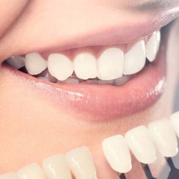 Porselen lamina yaprak diş kaplama Ankara Piano Dental Clinic