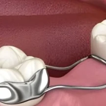 fissür örtücü | Piano Dental Clinic | Estetik Diş Hekimliği | Dental İmplantlar fissür örtücü